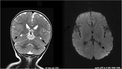 Case Report: Expanded delineation of phenotype of TRPM3-related neurodevelopmental disorders